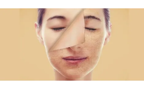 What to do if you overdid it with exfoliation (like I did)