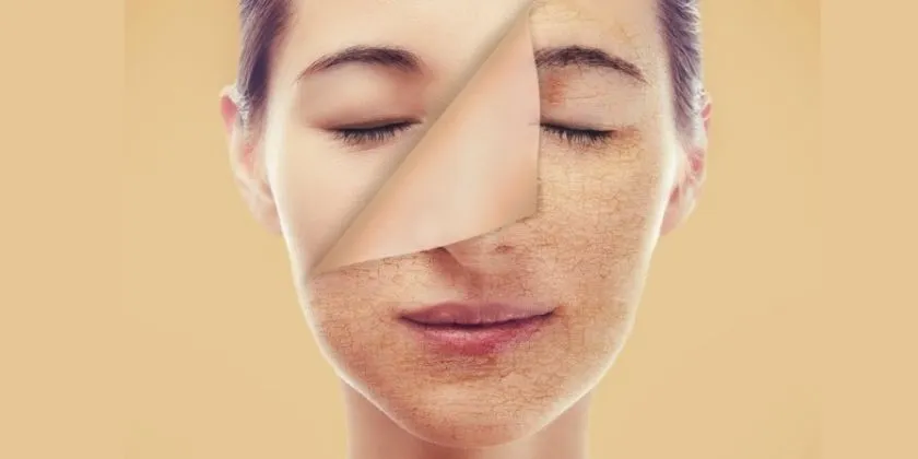 What to do if you overdid it with exfoliation (like I did)
