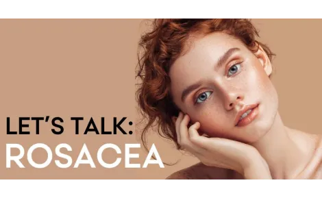 Let's talk: Rosacea