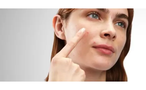 The perfect innovation from The Ordinary - Sulfur acne patches